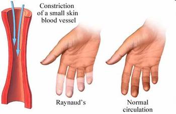 Intramedraynaud