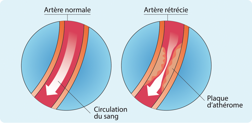 plaque formation